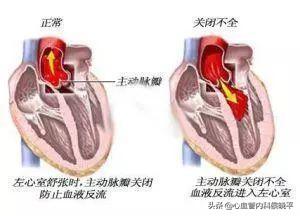 瓣膜|心脏“瓣膜反流”，是心脏病吗？