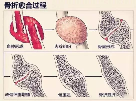 骨折|骨损伤康复不能只靠“喝骨头汤”| 健康长寿36计