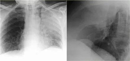 一文总结肺不张的影像学表现丨以影识病
