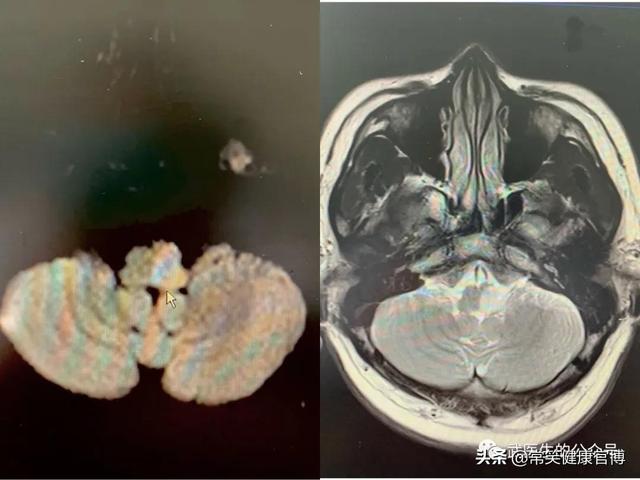 细细一根胃管，是吞咽困难重症病人的救命稻草