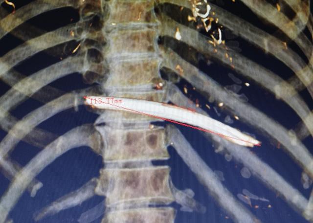 胆大！嫌脖子上的透析管碍事，七旬老太自己剪断了！部分导管“游”到了心脏