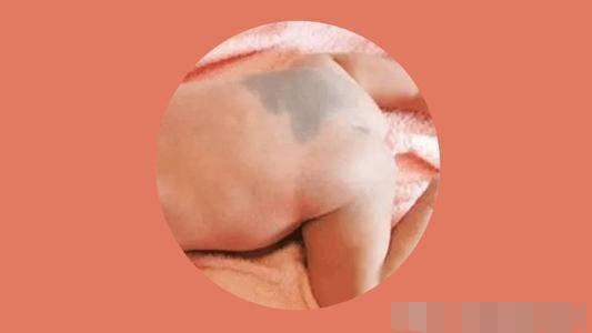 亲人族|很多宝宝出生后屁股上为何有乌青？准妈妈应知道原因对策和预防