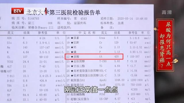 尿酸|尿酸只高一点，也可能得肾癌！少做这三件事，把尿酸降下来