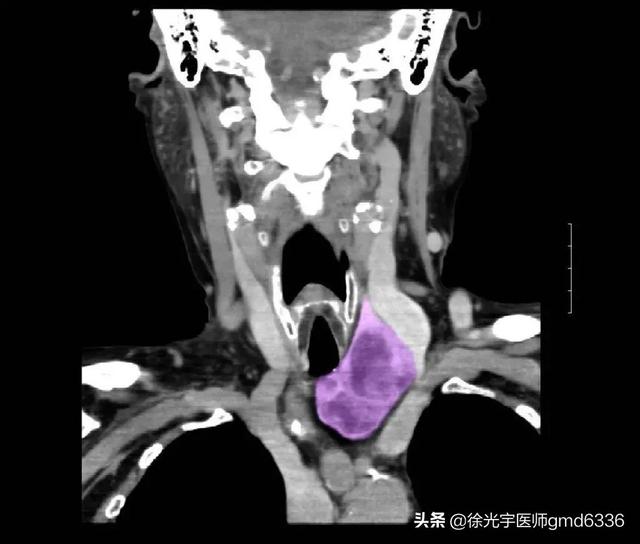 甲状腺肿瘤虽是“懒癌”，但也要积极检测、治疗，早发现早解决