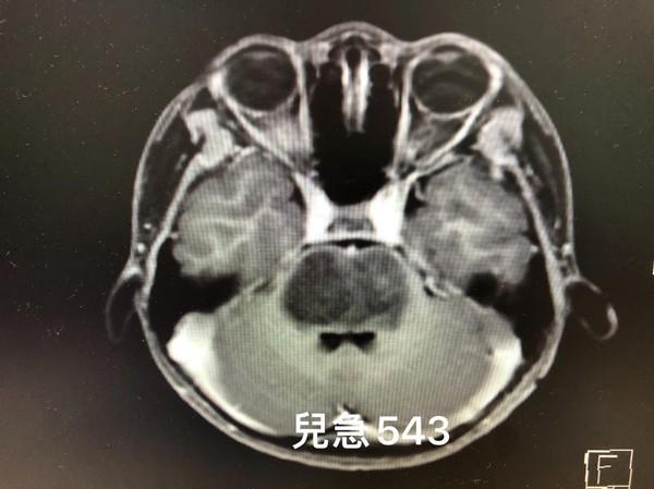 你的育儿经|小孩突脸歪、四肢无力！医揭1疾病家长恸