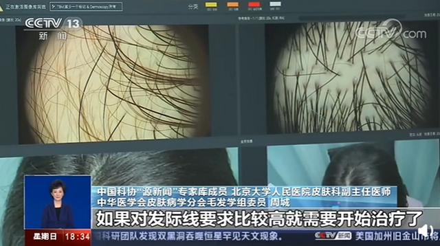 我国超2.5亿人受脱发困扰，这样可自测脱发程度，网友：不敢测