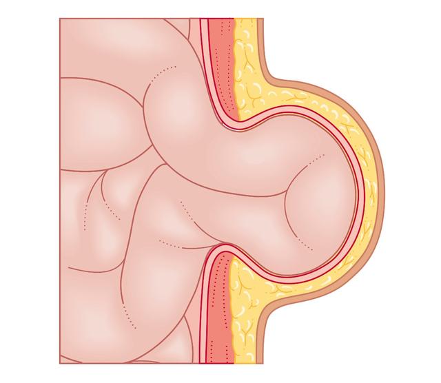 手术|莫以“疝”小而不为，需及时就诊