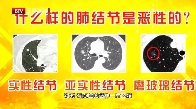 没有不良嗜好，为何还会得肺癌？可能身体里有一个肺癌“驱动器”