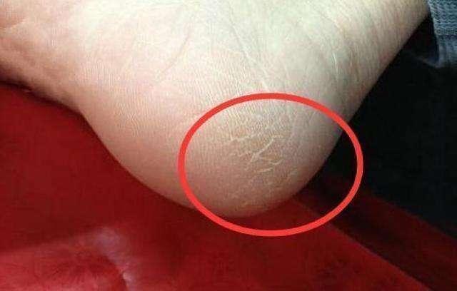 极简装修指南:脚后跟干裂严重,几件事每天都做好,能缓解不少干裂问题