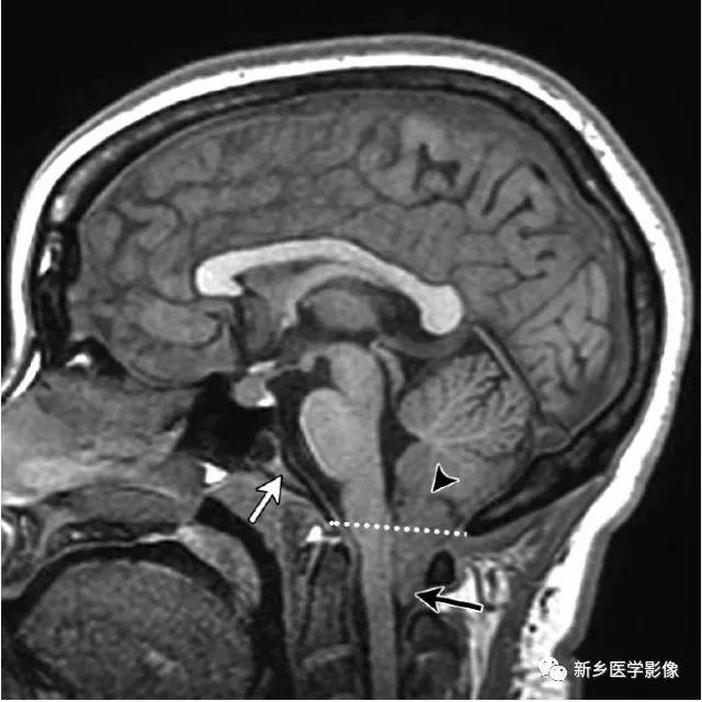 大脑中线处常见的25种疾病