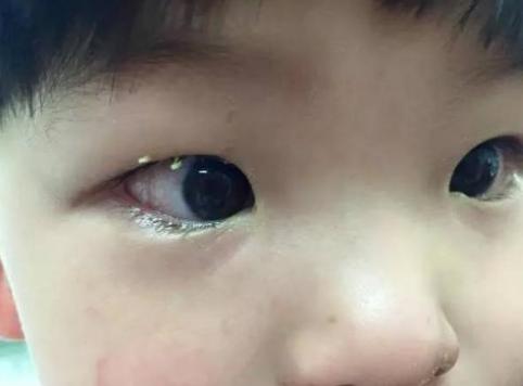 小酒窝|5岁宝宝突然“失明”，家人以为是上火，检查后医生：来晚了