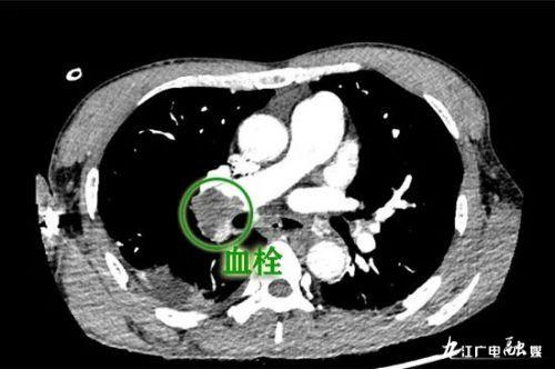 九江学院附属医院开展两例肺栓塞经皮肺动脉导管介入下碎栓、溶栓（取栓）术