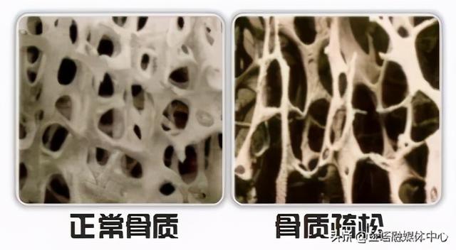预防骨质疏松，这几点请记住
