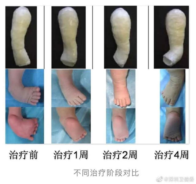 小酒窝|每年都有一些父母，因不知道这个疾病可治愈，而放弃胎儿生命