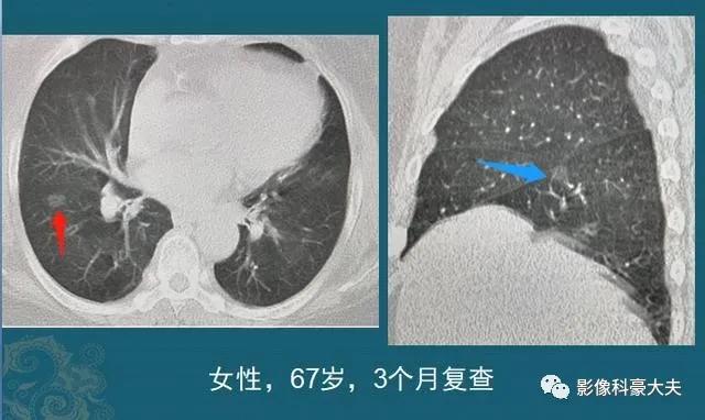 磨玻璃结节1cm，要不要动手术？看看影像科医生的分析