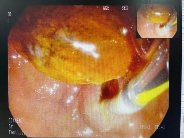 95岁老人胆总管结石腹痛难忍，医生20分钟取出2.5cm结石