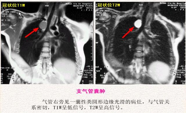 6种常见纵隔肿瘤的影像解读与鉴别要点，一文击破