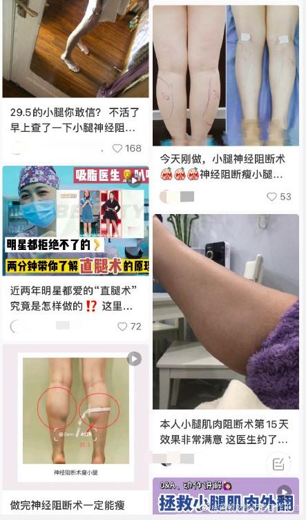 小腿|女孩为瘦腿切断小腿神经，医生、大V都在警告