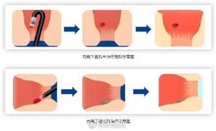 痔疮|蹲坑玩手机小心成有痔青年