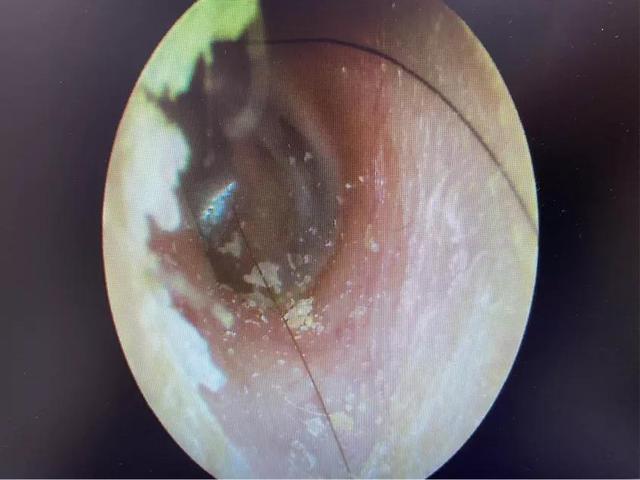 耳朵奇痒难耐？掏耳朵解决不了问题