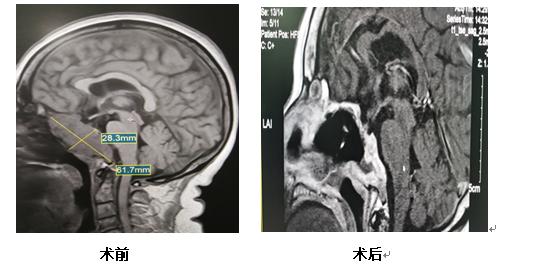 大妈|可怕！大妈流“鼻涕”长达一个月，医生却说：“你流的是脑脊液”......