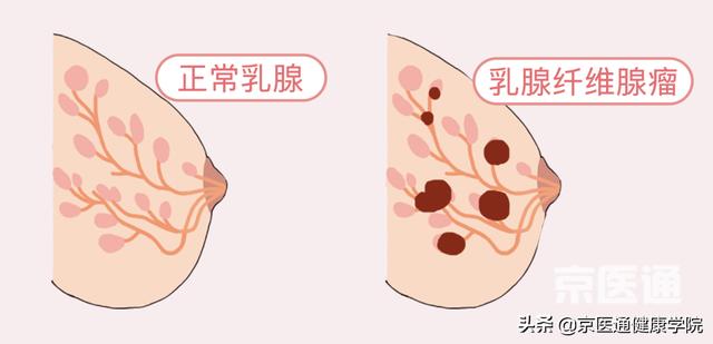 乳腺增生、结节、癌，摸起来什么感觉？医生教你分辨