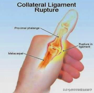 关节囊|打篮球手指受伤养半年还肿痛，拍片骨头没事，应该手术还是康复呢