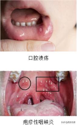 疱疹|近期儿童高发！已有多个班级停课