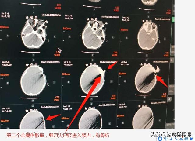你的育儿经▲熊孩嬉闹 剪刀入脑 上篇飞刀 这个更孬
