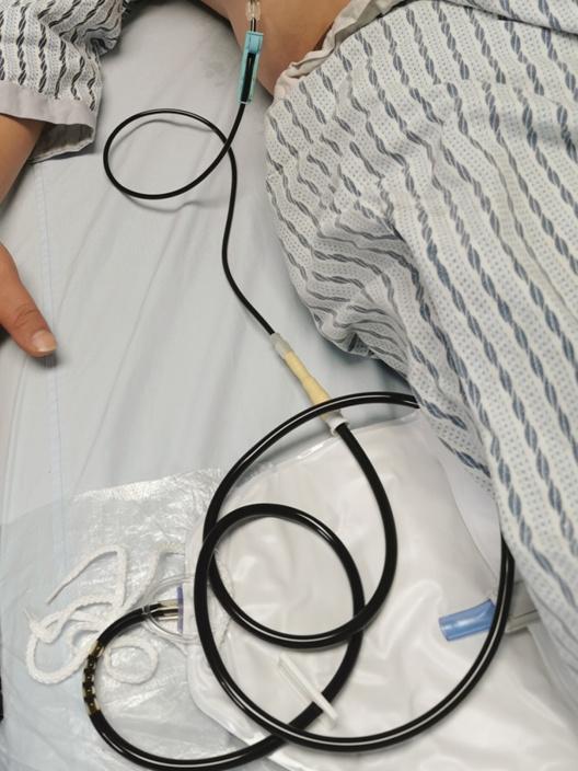 超声|胆囊炎急性发作却不能手术怎么办？这个方法为他赢得手术机会