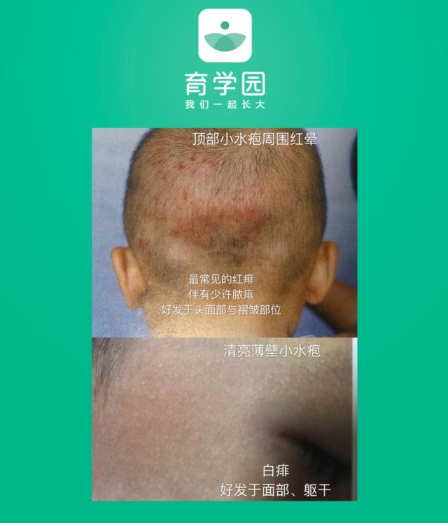 【你的育儿经】宝宝皮肤变红、发痒、起皮、破溃怎么办？崔玉涛医生这样说