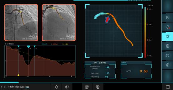 要不要放支架？这个最新检测方法很“硬正”省人医在江苏率先开展