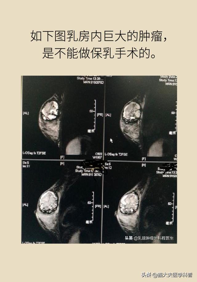 医生，能不能别切掉我的乳房？