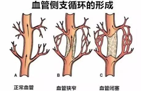 动脉|警惕血管堵了没察觉！血管堵塞竟然这么难发现吗？