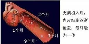 血管壁|冠脉放支架，斑块哪儿去了？