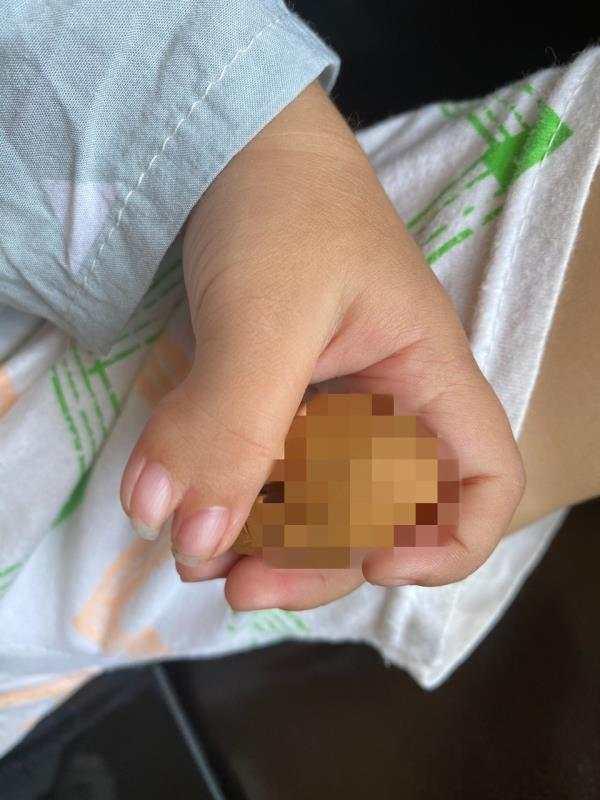 畸形|18岁女孩夏天也戴手套，医生提醒：孩子手疾要选择最佳手术时间