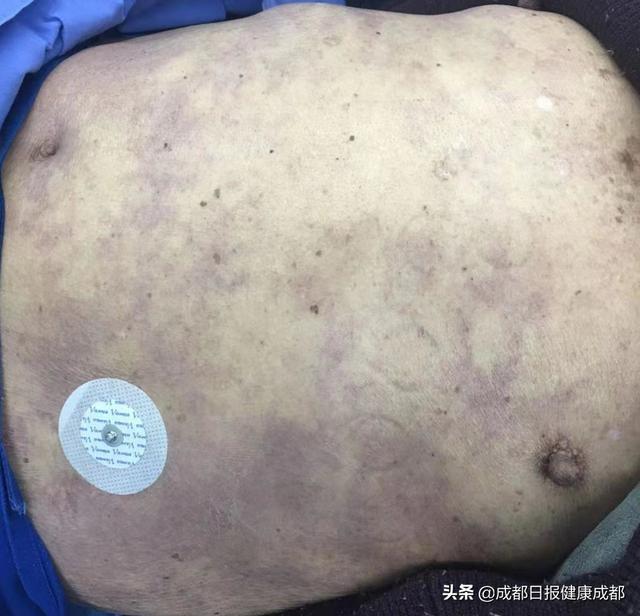 患者|24分钟打通老人堵塞血管！成都市五医院又一次印证区域协同作战重要性