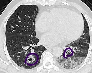 肺部|大伯肺里刮“台风”？竟然已是癌症晚期