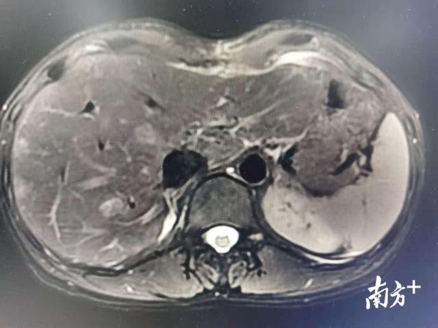 罕见！深圳市三院成功救治深圳首例“肝紫癜”患者