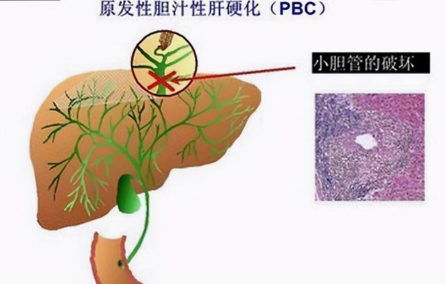 当患者出现尿路感染时，我们应该怎么办呢？我们要怎么治疗？