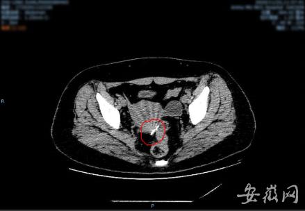 合肥女子腹中藏针30年 腹腔镜联合超声内镜精确定位顺利取出