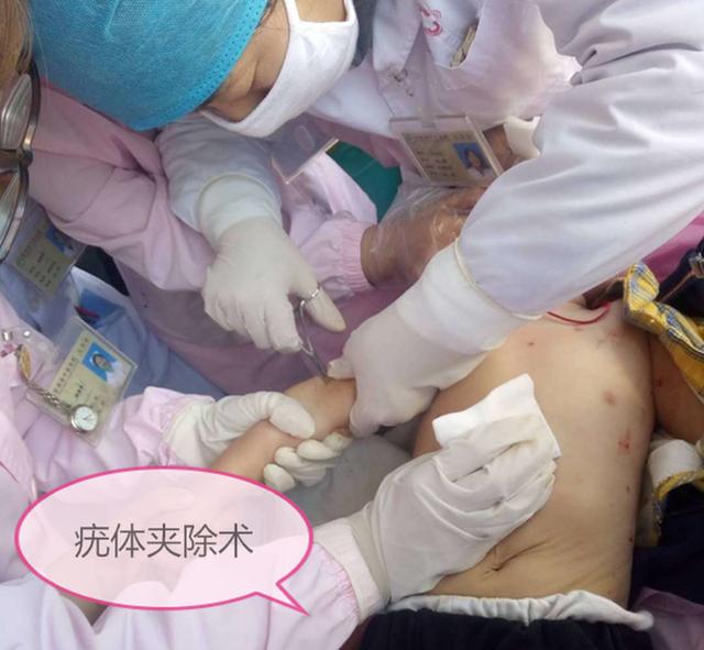 【你的育儿经】富源：医生教你如何预防 辨别 治疗，宝宝感染“水瘊子”