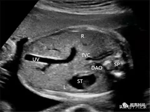 你的育儿经|胎儿下腔静脉缺如