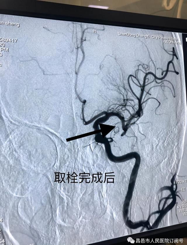 跟血栓say goodbye——昌邑市人民医院神经内二科颅内介入动脉取栓术纪实