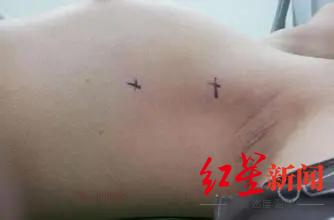 交感|双手出汗多也是病？22岁的他有一双“水手”，能让手机进水……