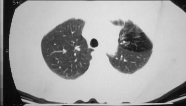 一文总结囊性纤维化的肺部影像学特征｜相“影”成趣