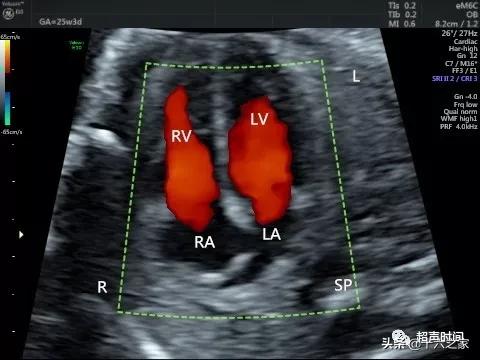 你的育儿经|胎儿下腔静脉缺如