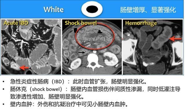 什么是 CT 增强？强化程度、模式、扫描时相等问题逐一解答