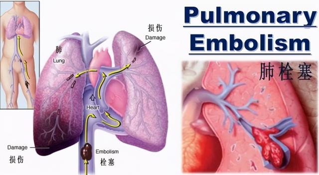 WebMD：对于疾病，不同的血型，不同的影响