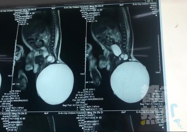 超级宝妈■发病率三万五千分之一！男婴竟长出“球形尾巴”，出生6小时后西安医生为他手术
